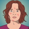 Remédio acne com formação de cisto
