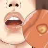 Curando uma inflamação na boca