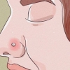 Tratando um piercing no nariz inflamado
