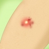Tratamento de uma infecção estafilocócica