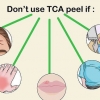 Aplicando um peeling de tca