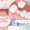 Reparando uma coroa dentária perdida
