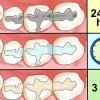 Cuidar de uma obturação em um dente ou molar