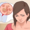 Tratamento de verrugas genitais em mulheres