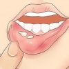 Reconhecendo o herpes