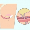 Faça exercícios de kegel