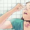 Tratamento de herpes labial no nariz