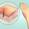 Tratamento de queimaduras leves