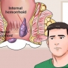 Como curar hemorróidas dolorosas