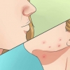 Livre-se da acne de forma rápida e natural
