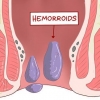 Usando hamamélis para tratar hemorroidas