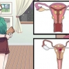Tratamento de cistos vaginais