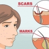 Livre-se das manchas vermelhas da acne