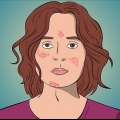 Remédio acne com formação de cisto