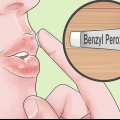 Trate rapidamente a acne ao redor dos lábios