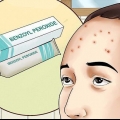Livre-se da acne na testa