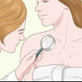 Livre-se das cicatrizes de acne no peito