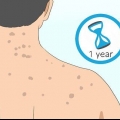 Livre-se das cicatrizes de acne nas costas
