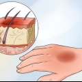 Tratamento de queimaduras