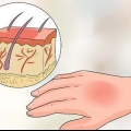 Tratamento de queimaduras por água quente