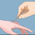 Remover agulhas de cacto