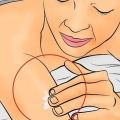 Tratando eczema