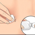 Tratando um piercing no umbigo irritado