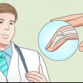 Tratando um dedo em martelo com uma tala