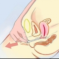 Removendo um preservativo desalojado do seu corpo