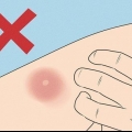 Tratando uma picada de mosquito