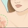 Tratando uma infecção fúngica da pele