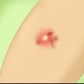 Tratamento de uma infecção estafilocócica