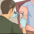 Remover uma tatuagem
