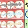Cuidar de uma obturação em um dente ou molar
