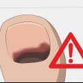 Como tratar uma unha preta