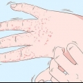 Tratamento de eczema nas mãos