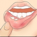 Reconhecendo o herpes