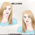 Tratamento da hiperpigmentação
