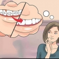 Preparando-se para o dia em que você colocar o aparelho