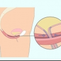 Faça exercícios de kegel