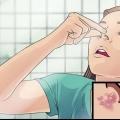 Tratamento de herpes labial no nariz