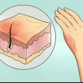 Tratamento de queimaduras leves