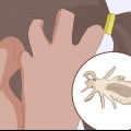 Prevenção de piolhos