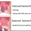 Como se livrar das hemorroidas naturalmente