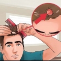 Como tratar a micose no couro cabeludo