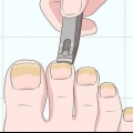 Tratamento de unhas fúngicas