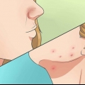 Livre-se da acne de forma rápida e natural