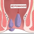 Usando hamamélis para tratar hemorroidas