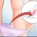 Prevenção de sangramento vaginal durante a gravidez