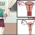 Tratamento de cistos vaginais